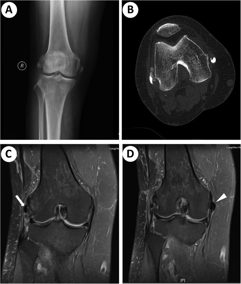 Four-panel medical imaging of a knee. Panel A: X-ray showing a frontal view of the knee joint. Panel B: CT scan with cross-sectional view of the knee. Panel C: MRI with arrow pointing to a specific knee ligament. Panel D: MRI with arrowhead indicating another knee feature.