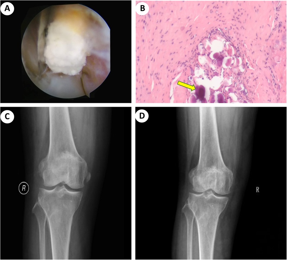 Panel A shows an arthroscopic view of a white mass in a joint. Panel B displays a histological section with a yellow arrow pointing to calcific deposition. Panel C shows a pre-operative X-ray of a right knee with calcific deposition. Panel D shows a post-operative X-ray of the same knee without calcification.