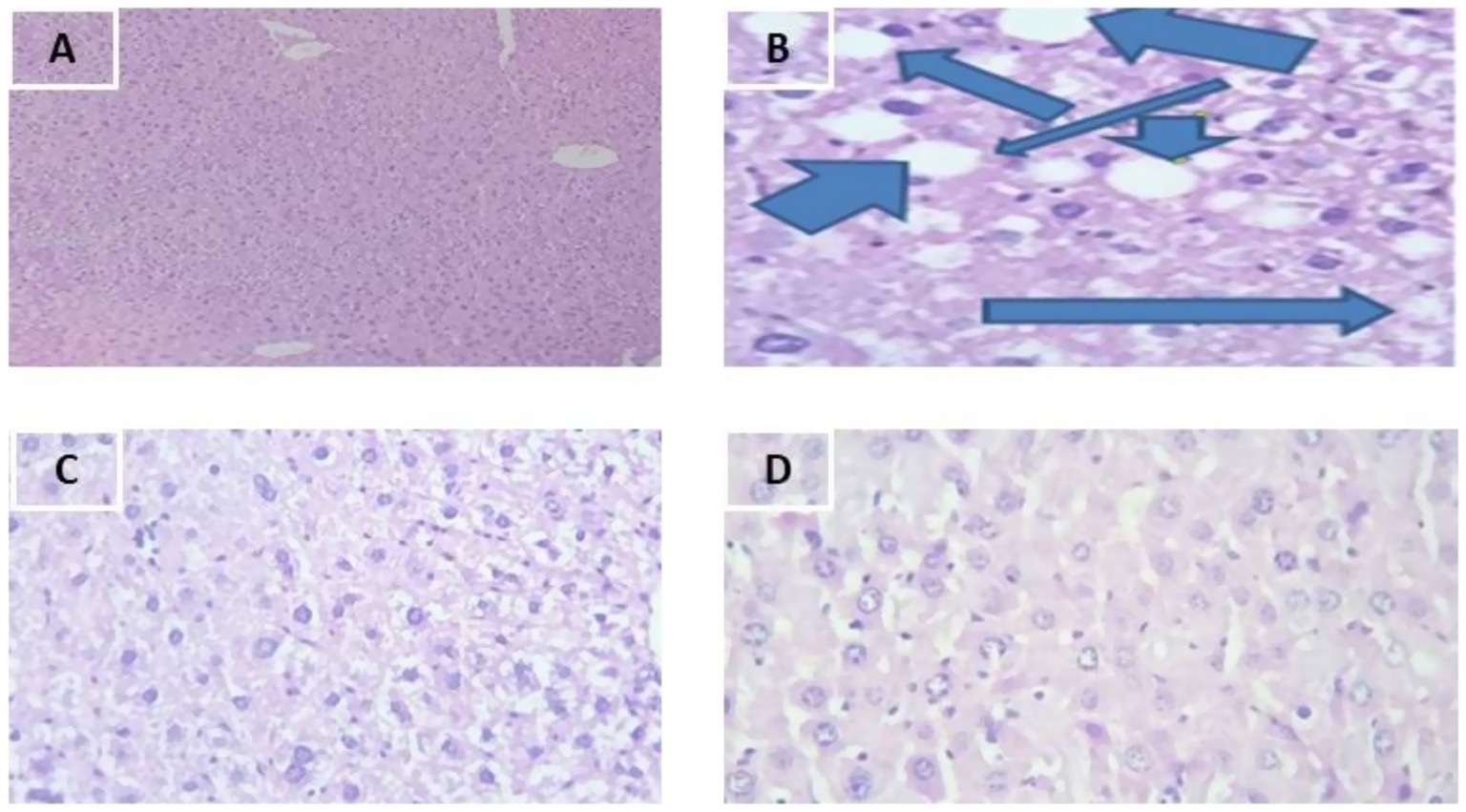 Four panels show histological images. Panel A depicts a section with normal liver tissue. Panel B highlights hydropic degeneration with arrows indicating cell swelling. Panel C illustrates steatosis with fat vacuoles. Panel D shows ballooning degeneration with enlarged, pale hepatocytes.