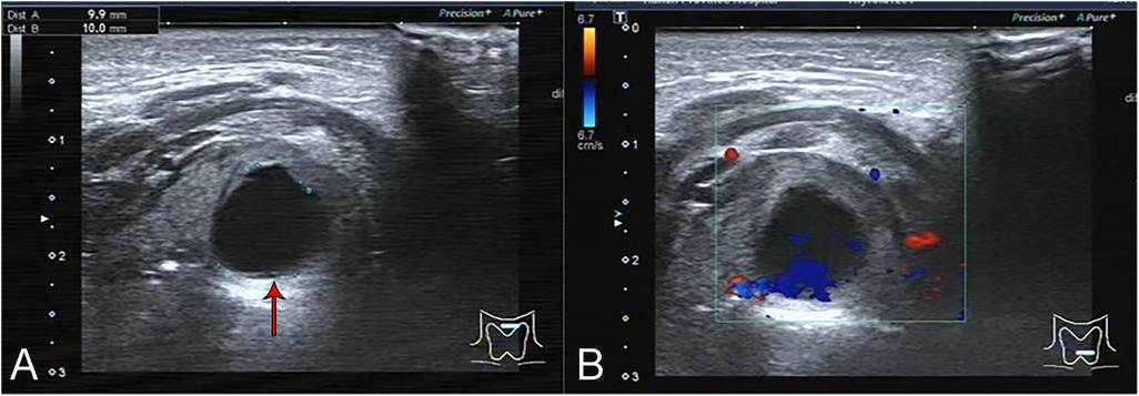 Ultrasound images labeled A and B. Panel A shows a circular dark region with a red arrow pointing to the border. Panel B displays the same structure with color Doppler highlighting areas of blood flow in red and blue adjacent to the structure.