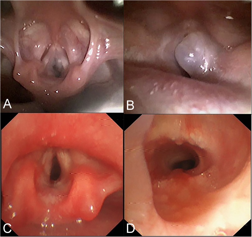 Endoscopic images showing different views of the larynx and trachea. Image A and B indicate a gray transparent cyst in the right subglottic region, obstructing the airway. Images C and D show no residual cyst or stenosis in the subglottic region after laser treatment.