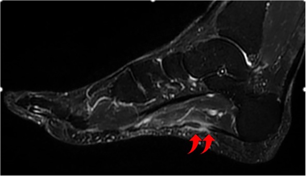 Frontiers Spontaneous rupture of the plantar fascia a case report