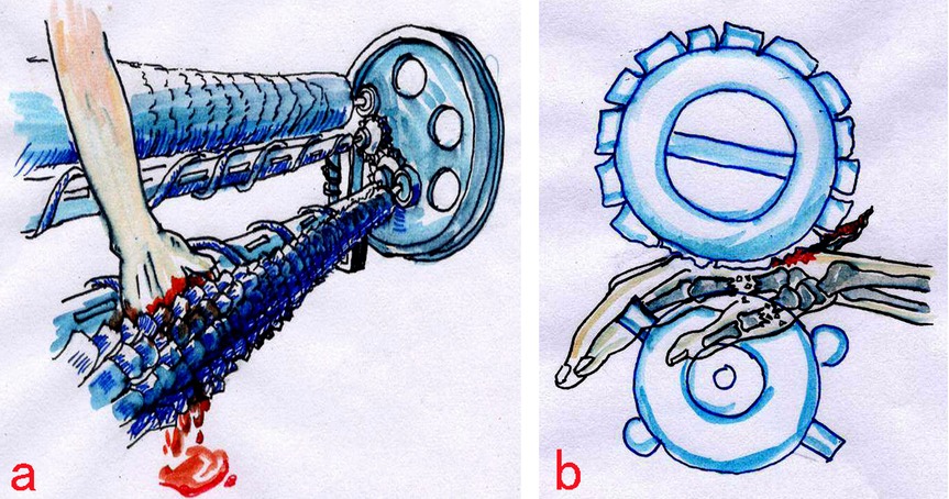 Illustrations depicting hand injuries caused by machinery. Image a shows a hand getting caught in a roller mechanism, resulting in bleeding. Image b displays a hand trapped between two gears, causing skeletal damage and bleeding.