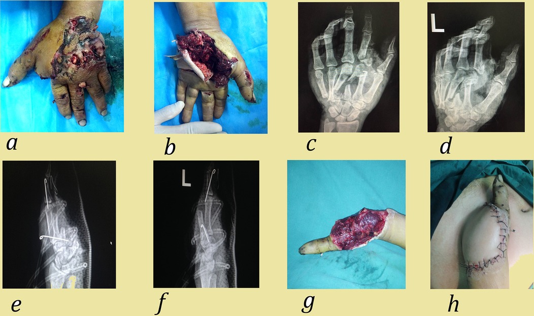 A set of eight medical images related to hand injuries and reconstruction. Image (a) shows a severely injured hand with exposed flesh. Image (b) presents a similar view with a focus on the palm. Image (c) is an X-ray of the injured hand. Image (d) is another X-ray showing a different angle of the hand. Image (e) is a side X-ray of a hand with metal pins. Image (f) provides another X-ray view with pins. Image (g) shows a close-up of a finger with a substantial wound. Image (h) displays a surgical reconstruction with stitches on the hand and arm.