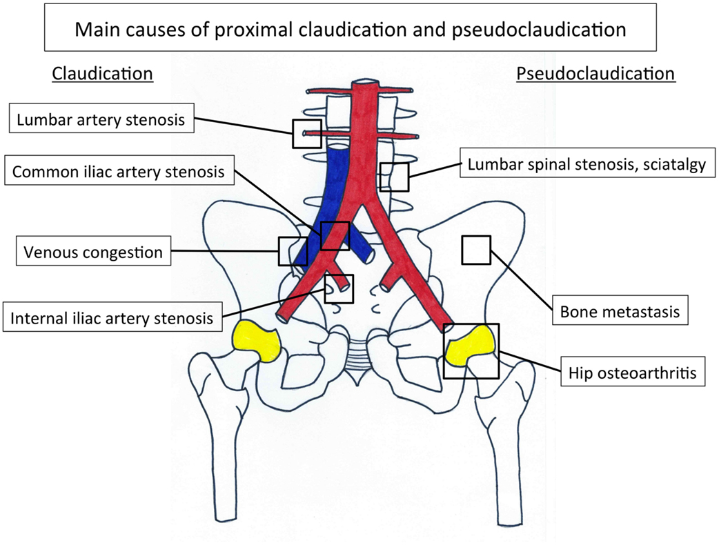 Frontiers Internal Iliac Artery Stenosis Diagnosis And How To Manage