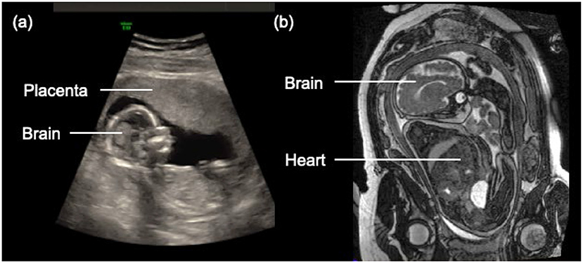 Figure 2 - (A) Ultrasound image of a baby.