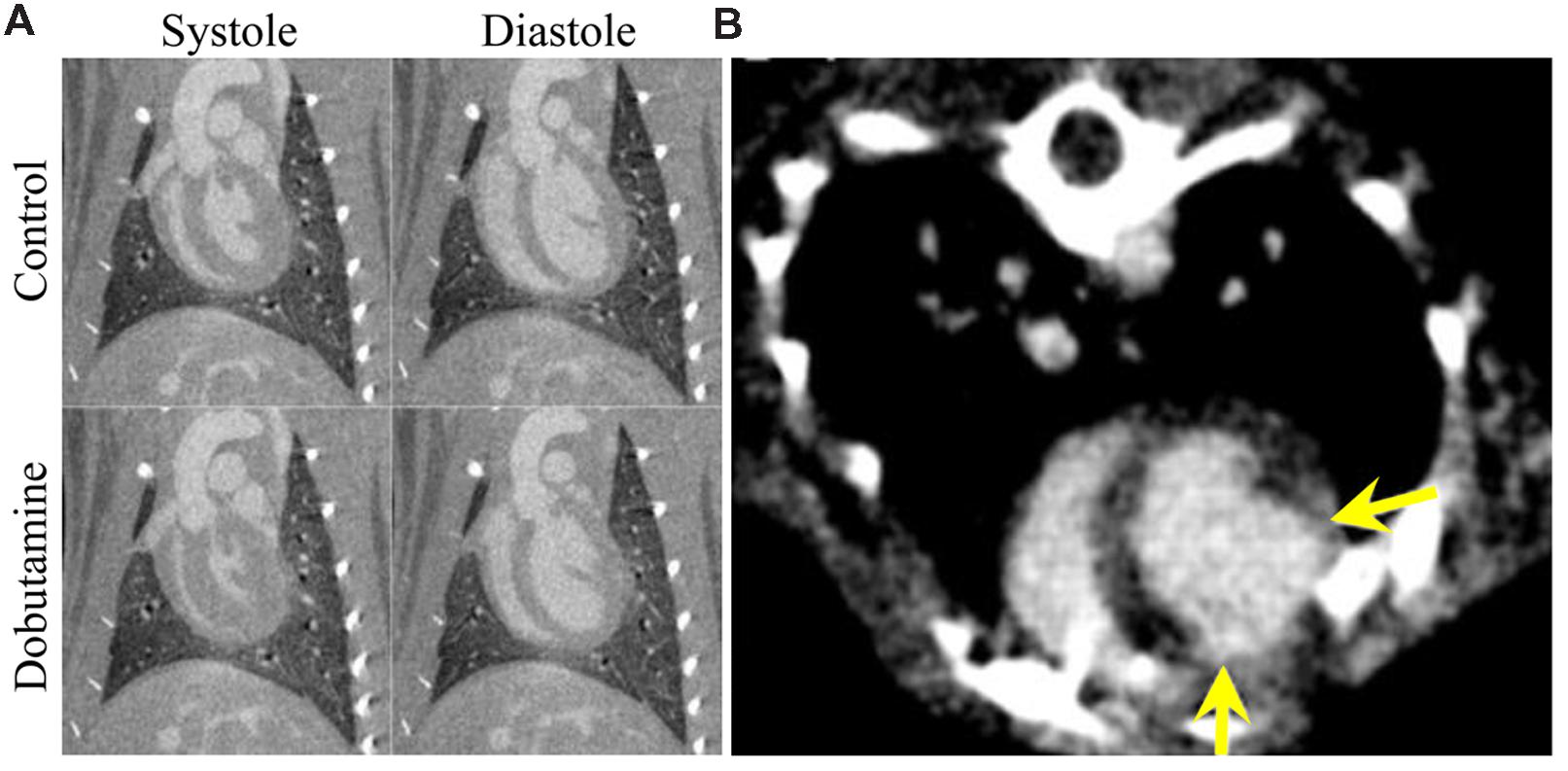 Micro CT picture of a breast carcinoma specimen.