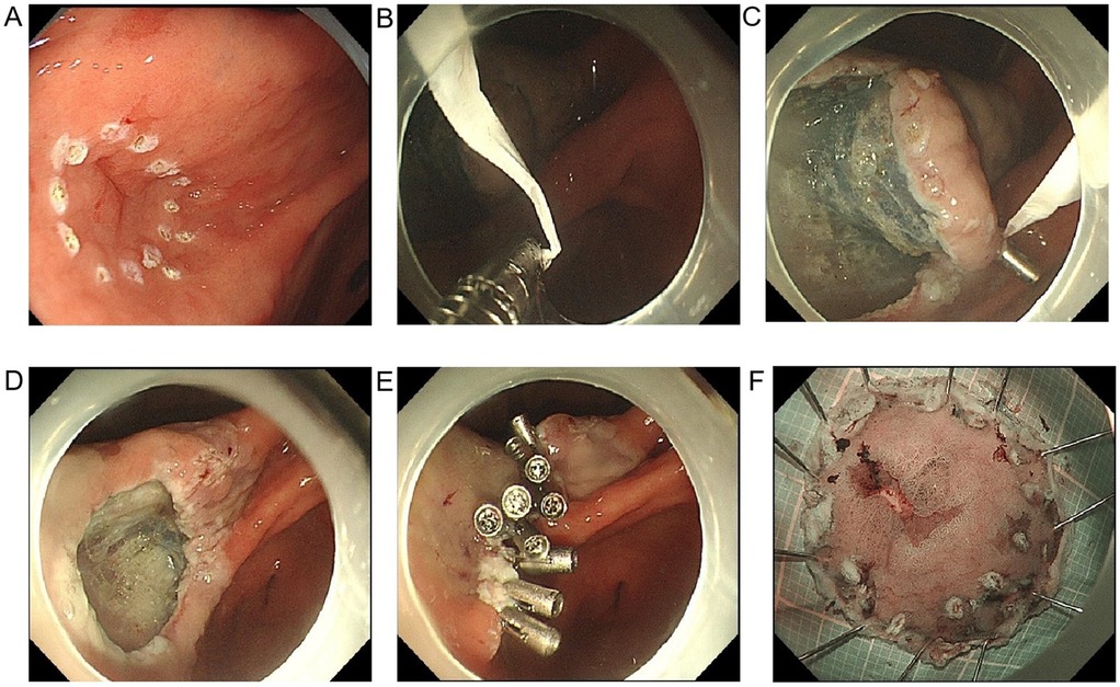 Endoscopic images depicting stages of a medical procedure. A shows a lesion with markings. B shows a tool cutting tissue. C captures elevated tissue during resection. D shows the post-resection area. E displays clips securing tissue. F presents the removed tissue specimen.