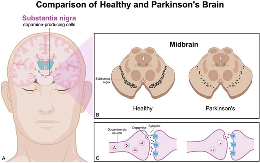Comparison of a healthy and Parkinson’s brain. Diagram A shows the location of the substantia nigra in a human brain. Diagram B compares the midbrain cross-sections, highlighting dopamine-producing cells in a healthy brain and their reduction in a Parkinson’s brain. Diagram C illustrates the synapse function, showing dopamine release from neurons.