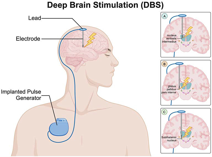 Illustration showing deep brain stimulation (DBS). A lead and electrode are implanted in the brain, connected to an implanted pulse generator in the chest. Insets A, B, and C detail stimulation areas: nucleus ventralis intermedius, globus pallidus pars interna, and subthalamic nucleus.