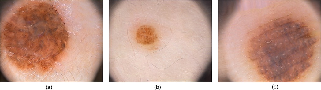 Three close-up images of skin conditions: a) Atypical Nevus - an irregular, darker brown lesion; b) Common Nevus - a smaller, evenly colored brown mole; c) Melanoma - a dark, irregularly shaped lesion.