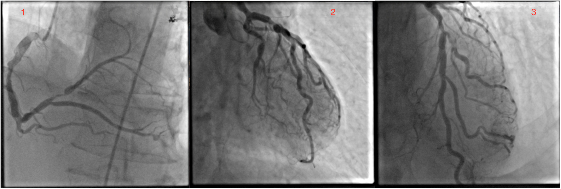Three-panel angiogram showing coronary arteries. \n\n1. Panel one: a clear view of a coronary artery extending across the image.\n2. Panel two: multiple arteries branching out at various angles.\n3. Panel three: detailed vascular structures with several branches visible.\n\nEach panel is numbered in red at the top.