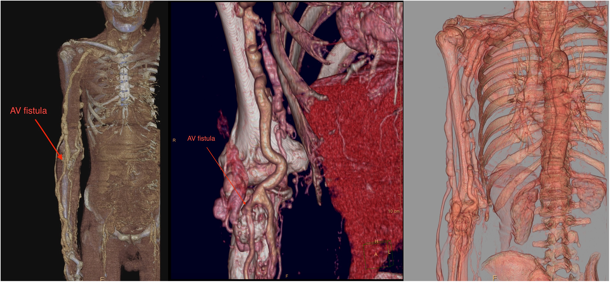 Three medical images display different views of the human chest and arm anatomy with an arteriovenous (AV) fistula marked by arrows. The left image shows a full-body view, the center image provides a close-up, and the right image highlights the chest and arm region. Bones and vascular structures are visible.