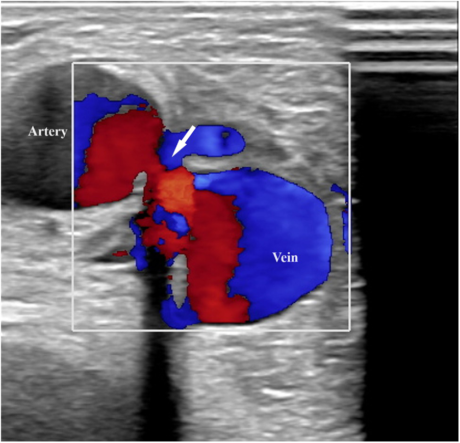 Color Doppler ultrasound image showing an artery labeled in red and a vein in blue. An arrow points to the vessel junction area.