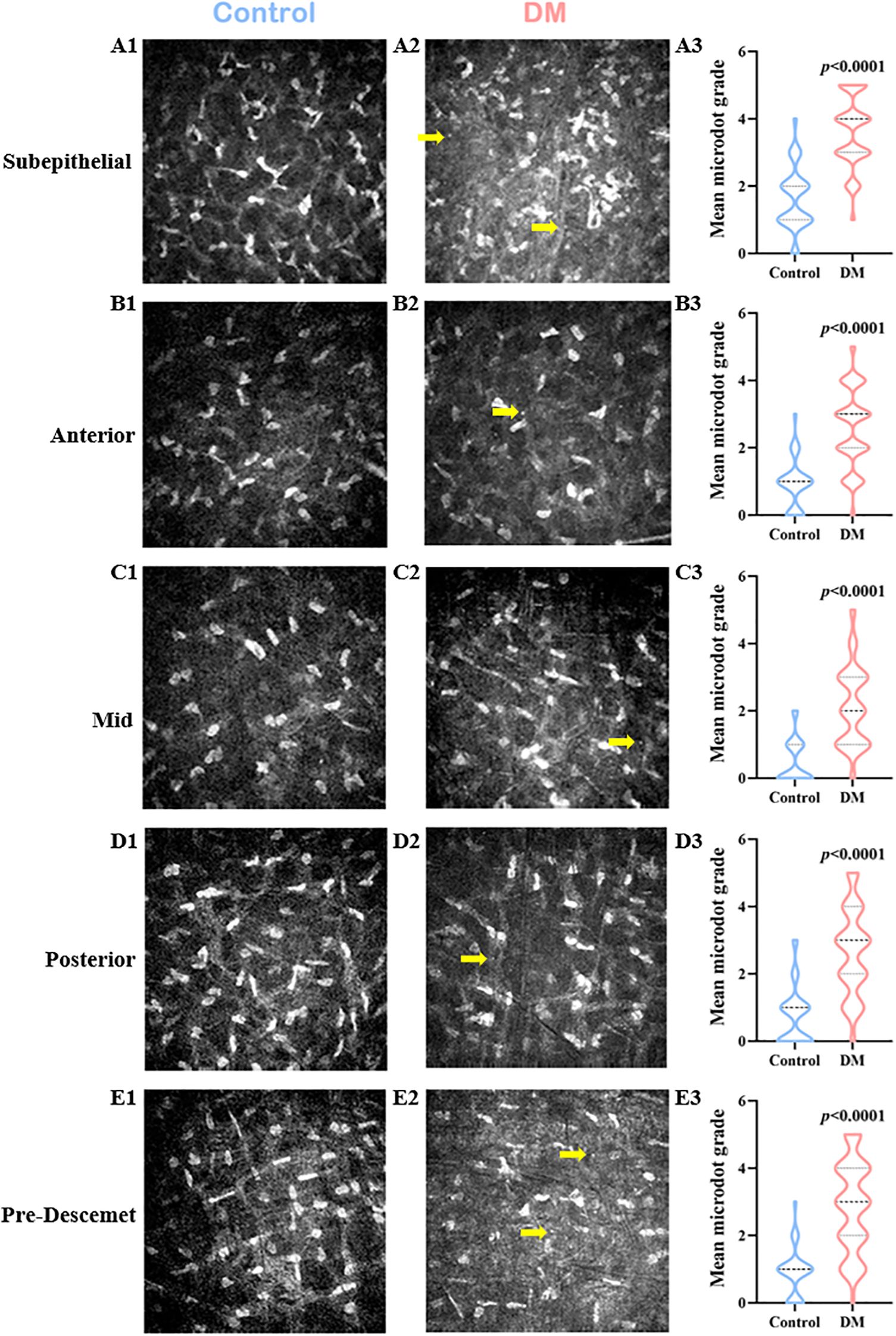 Comparison of corneal microdot patterns in control and DM groups across five layers: subepithelial, anterior, mid, posterior, and pre-Descemet. Control images (left column) display fewer microdots compared to DM images (middle column) with yellow arrows indicating areas of interest. Violin plots (right column) show significantly higher mean microdot grades in DM across all layers, with \(p<0.0001\).