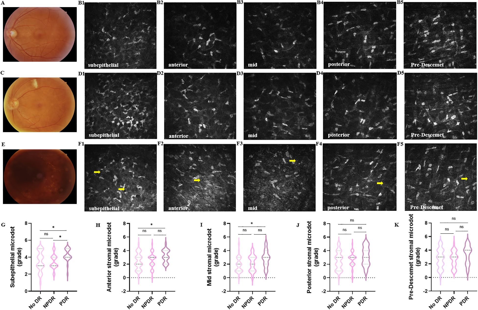 Retinal images and corneal confocal microscopy of three eyes (A, C, E) with corresponding detailed layers (B1-B5, D1-D5, F1-F5). Sections show subepithelial, anterior, mid, posterior stromal, and pre-Descemet layers, some with yellow arrow highlights. Violin plots (G-K) compare stromal microdot grades across non-diabetic retinopathy (No DR), non-proliferative diabetic retinopathy (NPDR), and proliferative diabetic retinopathy (PDR), with statistical annotations (ns, *) indicating significance levels.