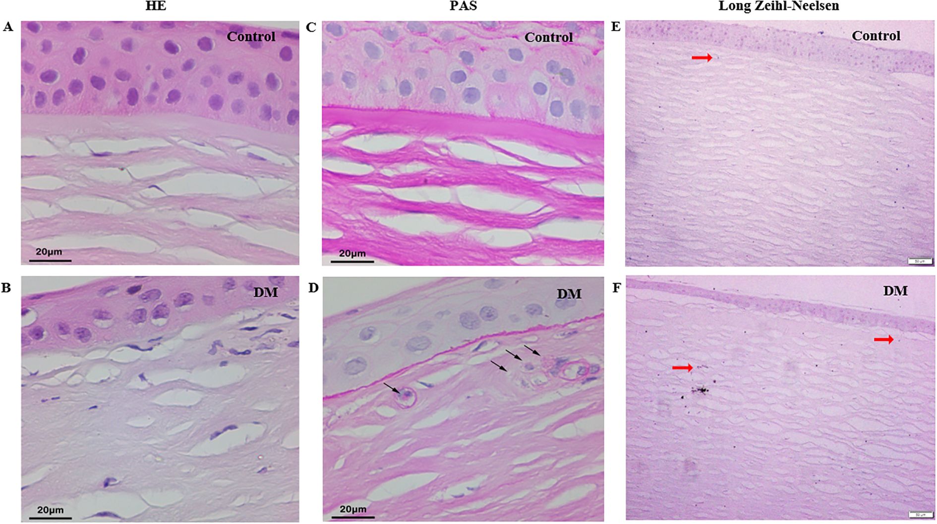 Microscopic images show tissue sections stained by different methods. Images A and B (HE stain) show healthy control and diseased (DM) samples, respectively, with distinct cell structures. Images C and D (PAS stain) highlight differences in glycogen presence between control and diseased tissues. Images E and F (Long Ziehl-Neelsen stain) display differences in bacterial presence, marked by red arrows, between control and diseased samples. Scale bars indicate magnification.