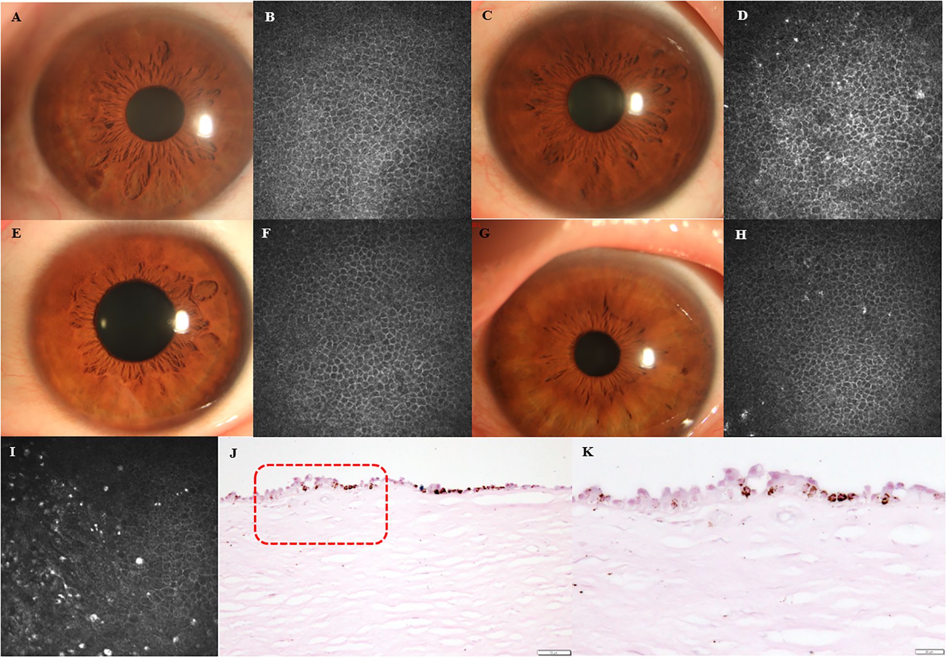 Panel A shows a close-up of a brown iris. Panel B is a microscopic view of corneal cells. Panel C depicts another close-up of a brown eye. Panel D shows corneal cellular details. Panel E features a brown iris, and F displays corneal cells. Panel G highlights a brown eye, while H shows corneal structure. Panel I presents corneal cells with distinct white spots. Panel J is a histological section with a red dashed area indicating a focus. Panel K is a close-up of tissue layers.