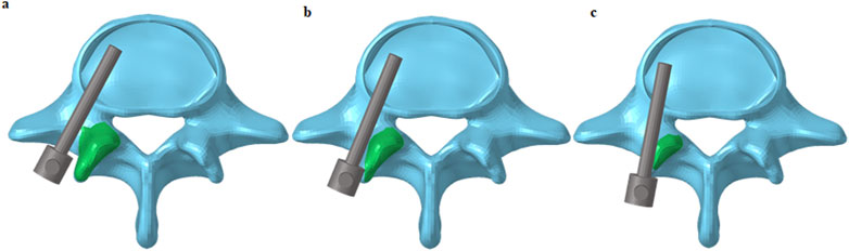 Diagram of three vertebrae models labeled a, b, and c show the placements of the screws.