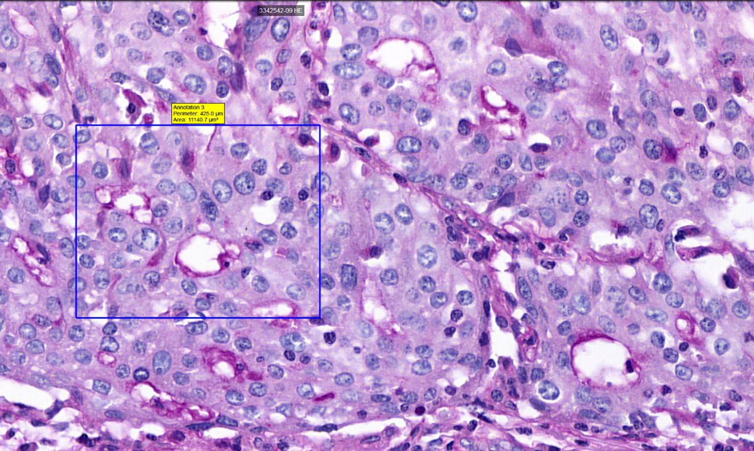 Microscopic view of tissue stained with hematoxylin and eosin, showing cells with darkly stained nuclei amidst a pink cytoplasmic background. A blue box highlights a specific area with annotation data indicating perimeter and area measurements.
