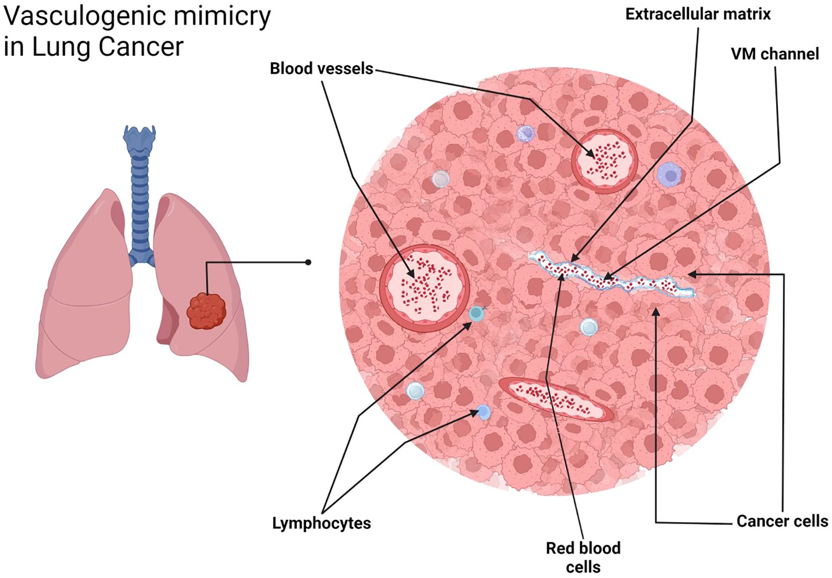 Illustration depicting vasculogenic mimicry in lung cancer. On the left, a diagram of lungs shows a tumor. On the right, a detailed view highlights elements like blood vessels, extracellular matrix, VM channel, lymphocytes, red blood cells, and cancer cells, labeled accordingly.