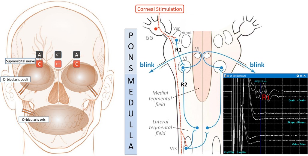 The setup, the pathway, and the typical BR IONM recordings are shown.