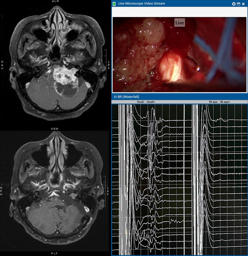 An illustrative case of left vestibular schwannoma with T1WI contrast MRI before (upper) and after (lower) operation. Intra-operative microscopic view shows that the cisternal portion of the trigeminal nerve is encased by the tumour. The left BR waterfall diagram shows preserved R1 waves throughout the operation. The tracing on the right shows no untoward movement artefacts detected by the control electrodes over the contralateral right eye.