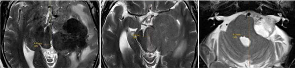 The maximal midline shift of brainstem is measured, using readily identifiable anatomical landmarks, namely cerebral aqueduct (left), mid-point of interpeduncular fossa, and median sulcus of the fourth ventricle in the T2WI MRI.