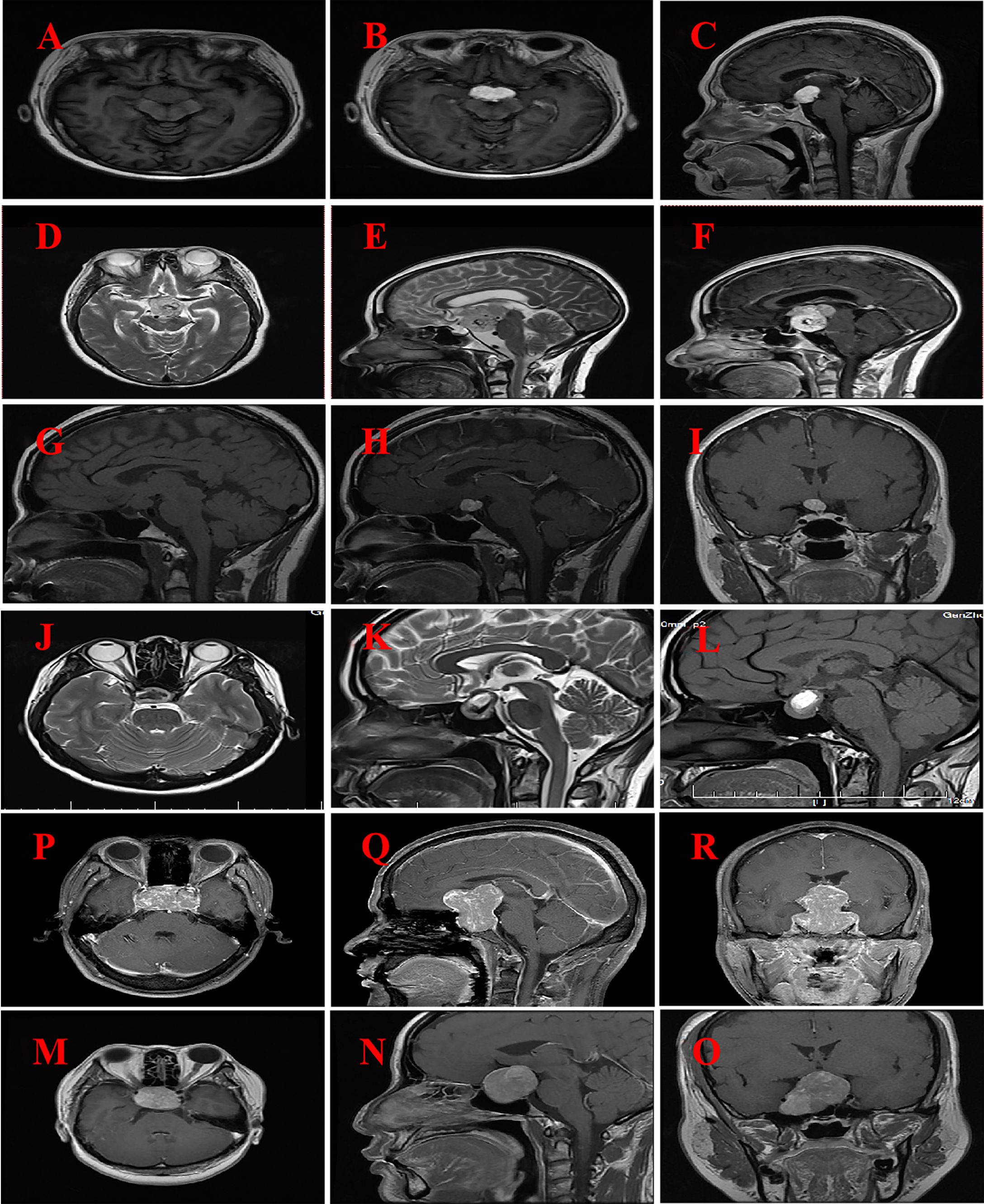 Medical imaging panels displaying various MRI scans of the brain. Each image showcases different orientations, including axial, sagittal, and coronal views, labeled from A to R. The scans reveal diverse brain structures, with varying levels of contrast and detail, highlighting areas of interest such as anatomical features and potential abnormalities. Bright and dark regions indicate different tissue types and densities. These images are likely used for diagnostic or research purposes to assess brain conditions.