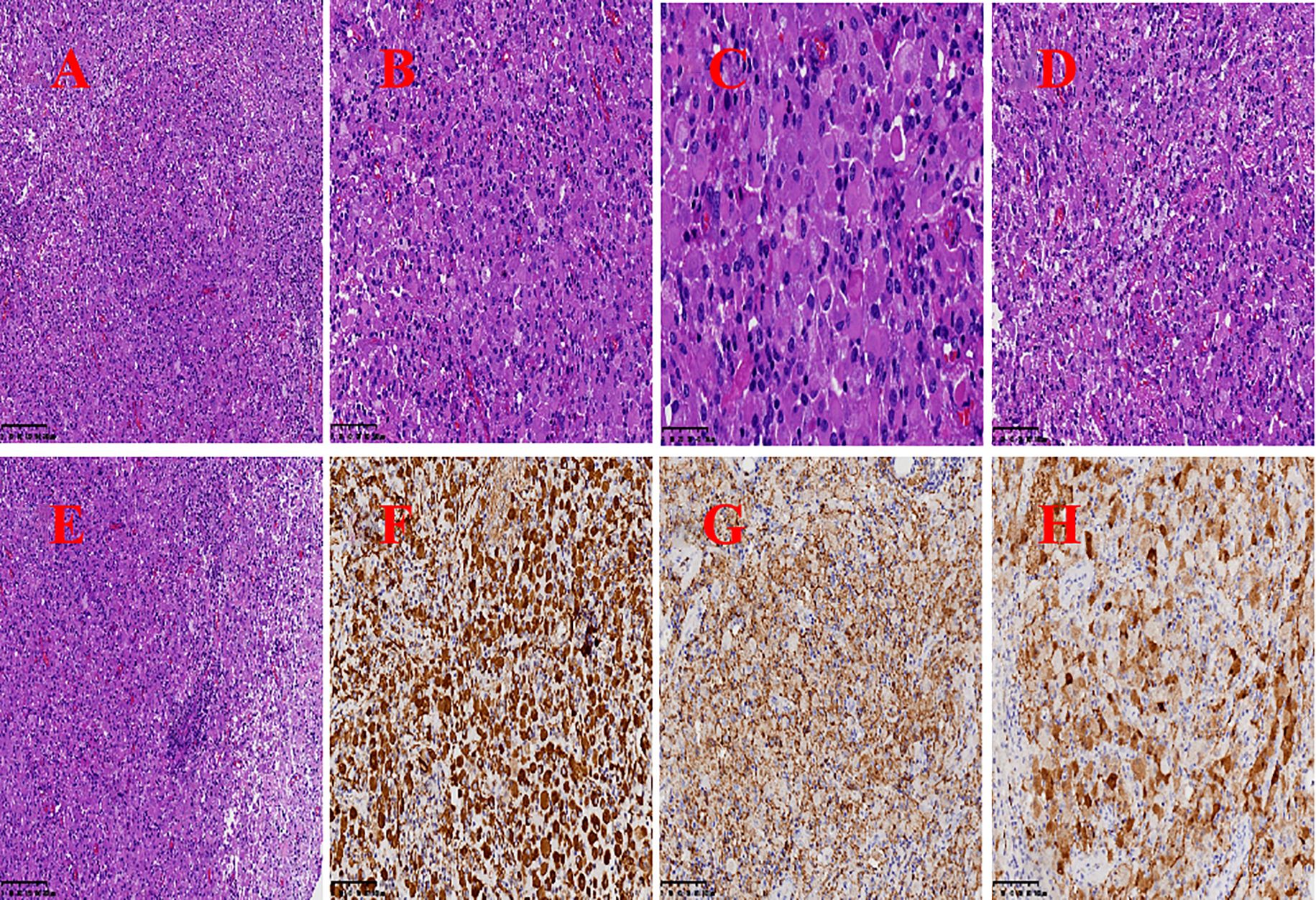 Microscopic images labeled A to H show tissue samples. A, B, and D display similar pink and purple staining patterns with dense cell clusters. C shows darker, concentrated cell structures. E resembles A, B, and D but with slight variations. F, G, and H exhibit a brown staining pattern, indicating a different analysis, with varying densities and distributions of the brown coloration. Each image includes a scale bar for size reference.