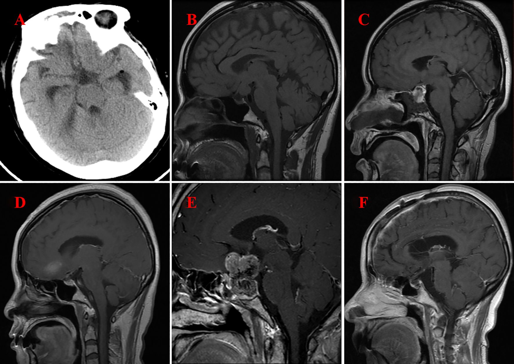 CT and MRI images of the brain in sagittal views labeled A to F, showing different sections and conditions. Images highlight various brain structures and potential abnormalities.