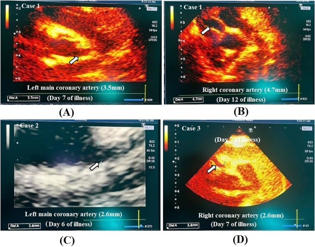 Four echocardiogram images showing coronary arteries. \n\n(A) Case 1 displays the left main coronary artery measuring 3.5 millimeters on day 7 of illness. \n\n(B) Case 1 also shows the right coronary artery measuring 4.7 millimeters on day 12 of illness. \n\n(C) Case 2 shows the left main coronary artery at 2.6 millimeters on day 6 of illness. \n\n(D) Case 3 displays the right coronary artery measuring 2.6 millimeters on day 7 of illness. Arrows indicate areas of interest in each image.