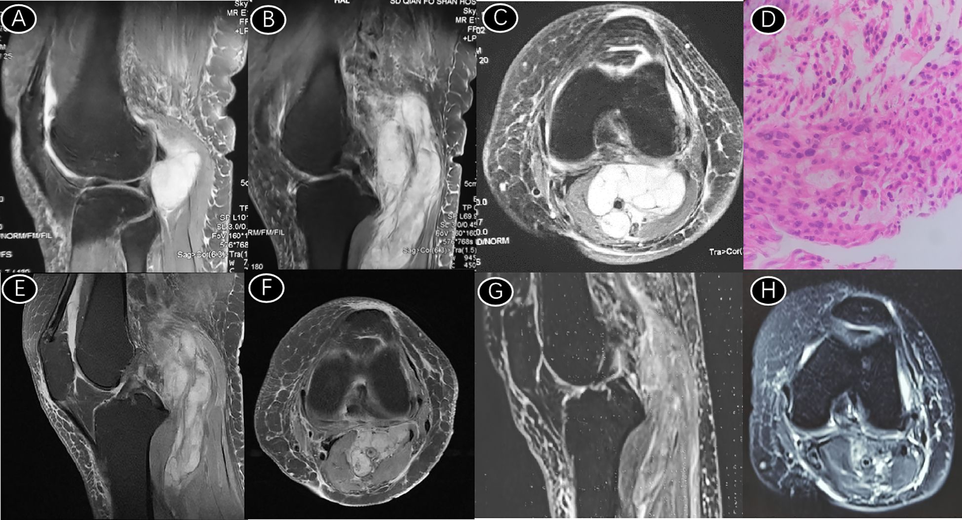 Series of eight medical images. (A-C) MRI scans showing a huge tumor in the popliteal fossa. (D) A histological section, stained pink and purple, showing a malignant spindle cell mesenchymal tumor. (E-F) MRI scans demonstrating that after 10 intensity-modulated radiotherapy sessions and 3 stereotactic radiotherapy sessions, the tumor boundary became more distinct and clearer than before. (G-H) MRI scans showing that after three months of anlotinib treatment, the tumor volume further shrank, and the boundary remained clear.