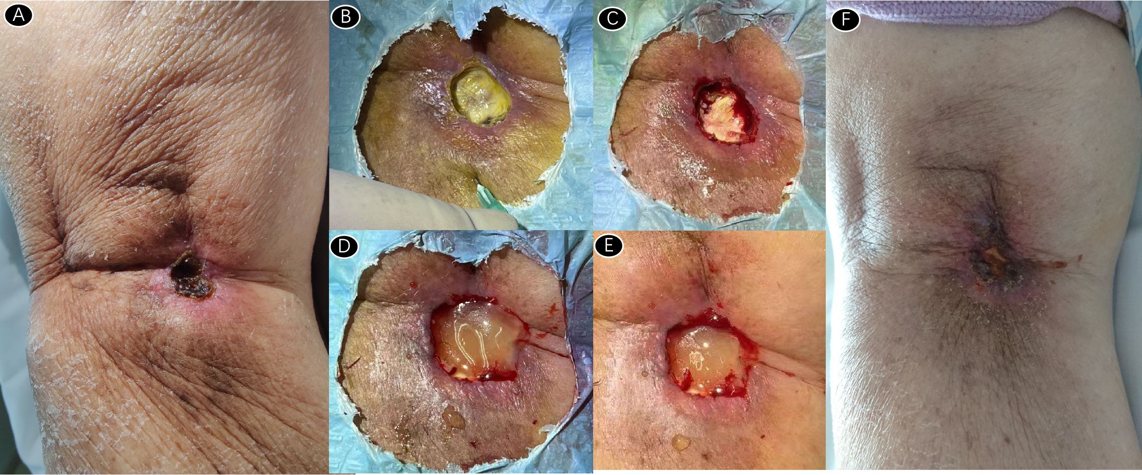 Six images labeled A to F, showing different stages of a skin condition and treatment. A depicts an initial lesion. B through E show progressive medical intervention, with surrounding skin marked and treated, revealing varied levels of tissue exposure and healing. F shows a healing wound with reduced inflammation and scabbing.
