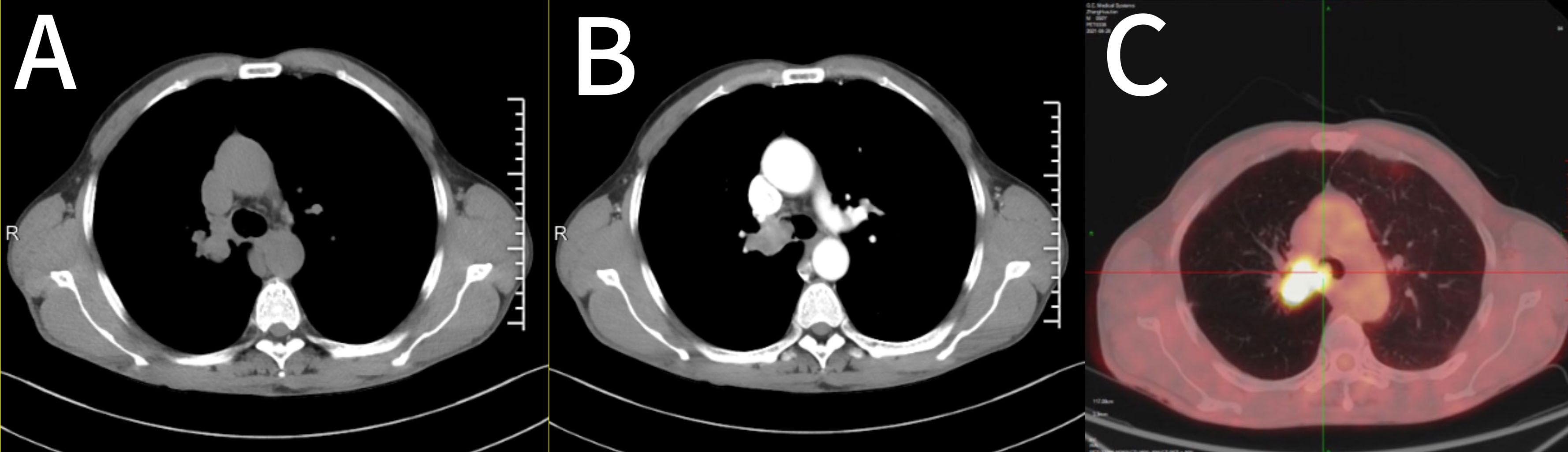 CT and PET scan images labeled A, B, and C show cross-sections of a chest area. Image A is a standard CT scan, B shows contrast enhancement, and C is a PET scan highlighting areas of metabolic activity with bright spots.