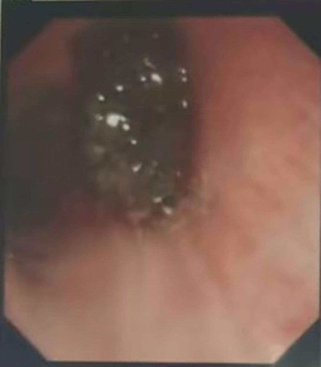 Endoscopic image showing a dark, irregularly shaped foreign object lodged in the esophagus, with surrounding tissue appearing reddish and inflamed.