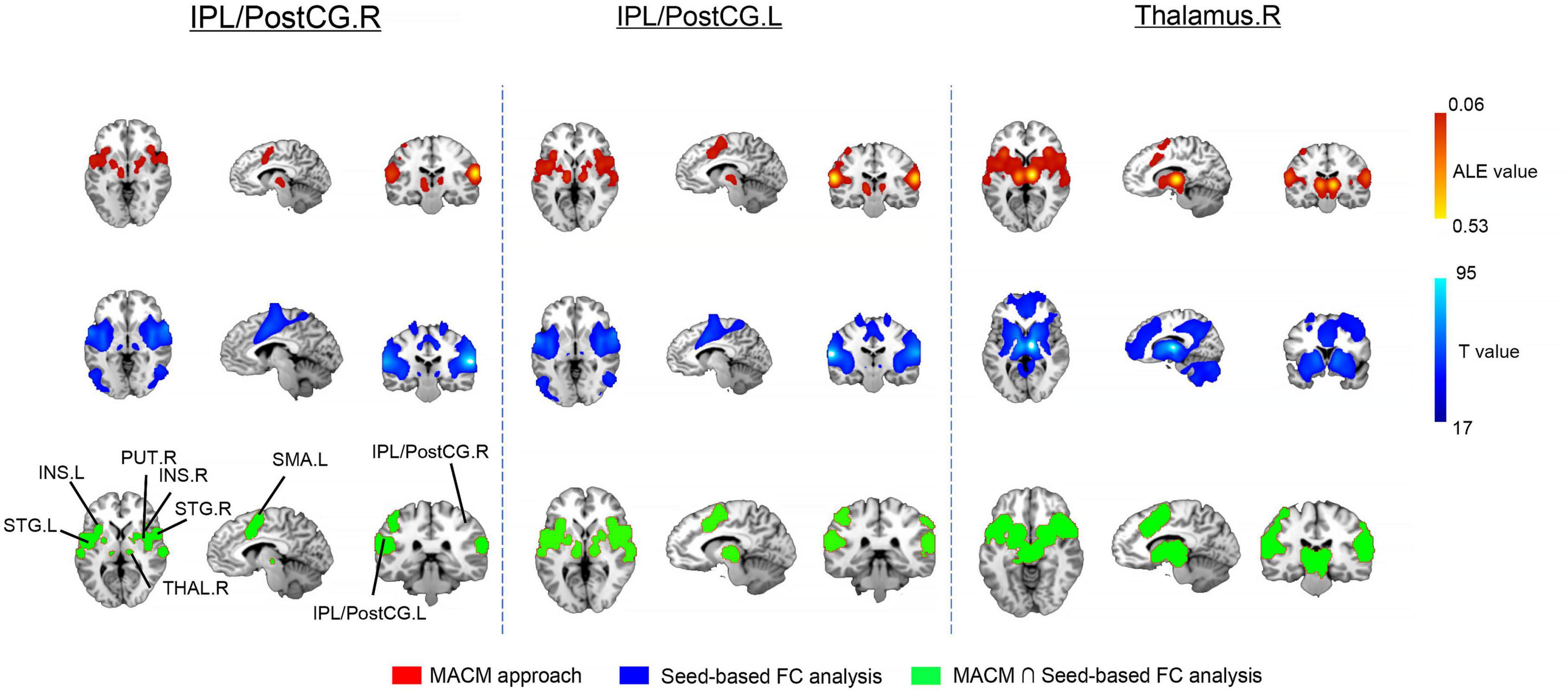 Brain scans in three columns show different regions with color-coded overlays. The first column is labeled IPL/PostCG.R, the second IPL/PostCG.L, and the third Thalamus.R. Red indicates MACM analysis, blue represents seed-based FC analysis, and green shows the intersection of both analyses. A color bar indicates ALE and T values, ranging from red (0.06) to blue (17). Key brain regions like INS, PUT, STG, SMA, and THAL are labeled.