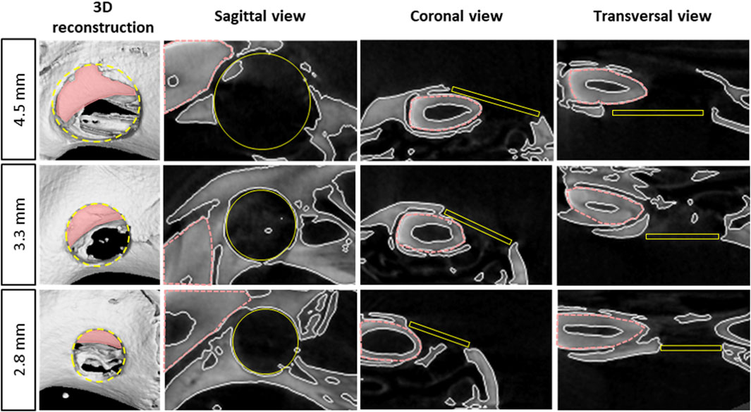CT scans of a bone lesion at three different sizes: 4.5mm, 3.3 mm, and 2.8 mm. Each row shows a 3D reconstruction, sagittal view, coronal view, and transversal view. Pink areas and yellow outlines highlight the lesion's position and size changes.