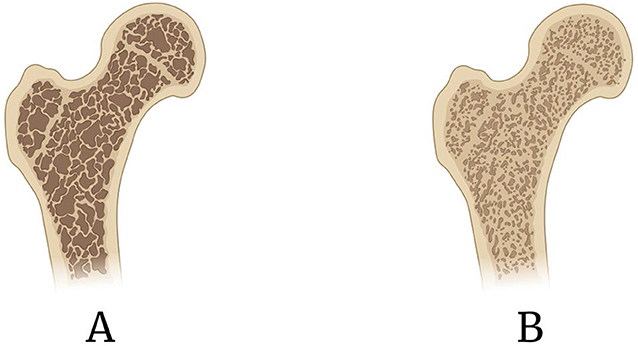 Figure 1 - (A) Healthy/young bone is strong and dense, with tightly packed structures.