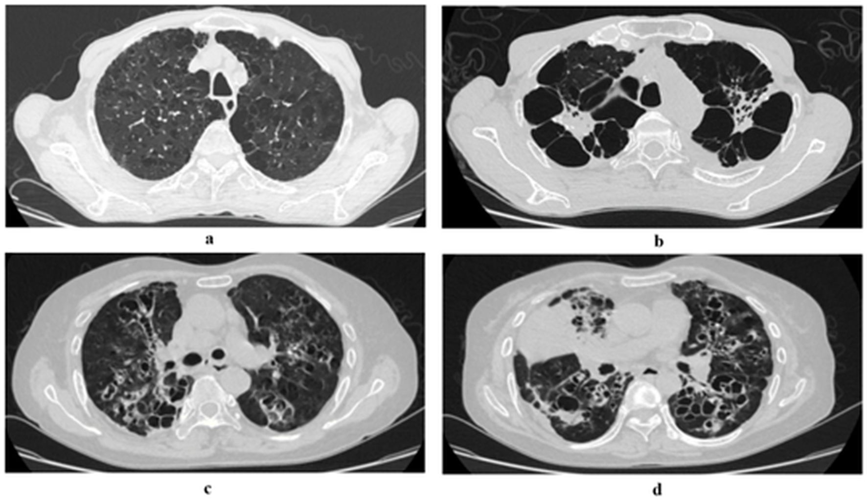 CT scans of four patients (panels a–d) with chronic lung disease and Aspergillus infection. The images show variable degrees of lung structural damage, including bronchiectasis, cavitation, and consolidation, corresponding to different stages or types of Aspergillus-related lung pathology.