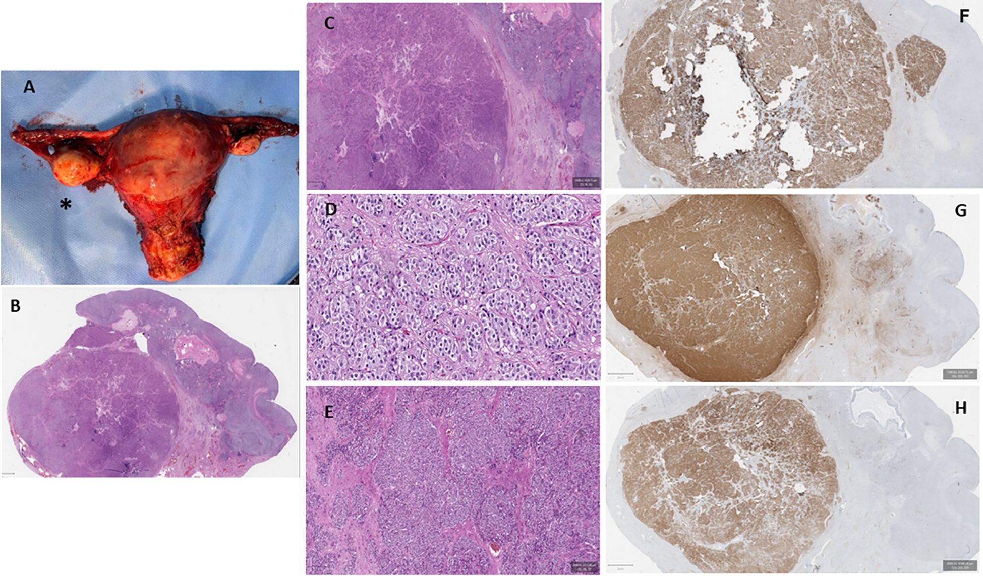 Image showing multiple panels of medical imagery. Panel A displays a gross anatomy specimen of a uterus with visible tumors. Panel B presents a histological section under a microscope, stained and highlighting cellular structures. Panels C, D, and E show magnified views of tissue with varying levels of detail, revealing complex cellular arrangements. Panels F, G, and H display immunohistochemical staining, indicating different intensities and patterns, suggesting varied tissue characteristics or conditions.