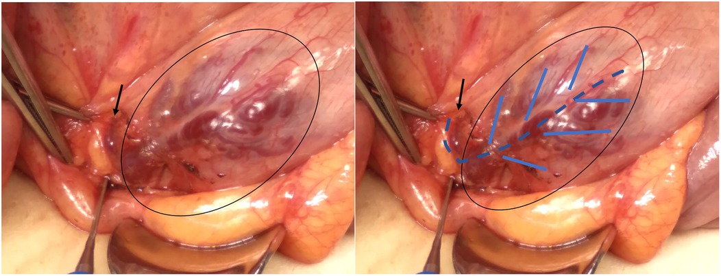 Surgical image showing an exposed section of internal tissue with visible blood vessels. The left panel highlights a specific area with arrows and an oval, while the right panel includes additional blue arrows. Surgical tools are also present.