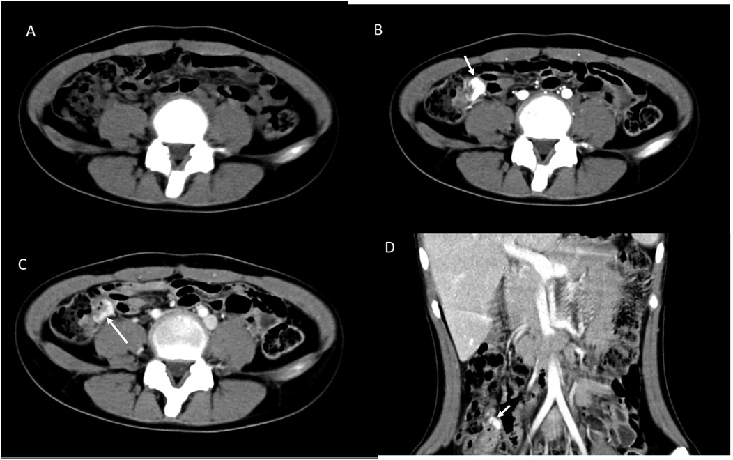 CT scan images labeled A to D show abdominal cross-sections. Image A shows a baseline view. Images B and C display arrows pointing to areas of interest in the abdominal region, indicating potential abnormalities or changes. Image D provides a coronal view with an arrow highlighting a specific area for examination.