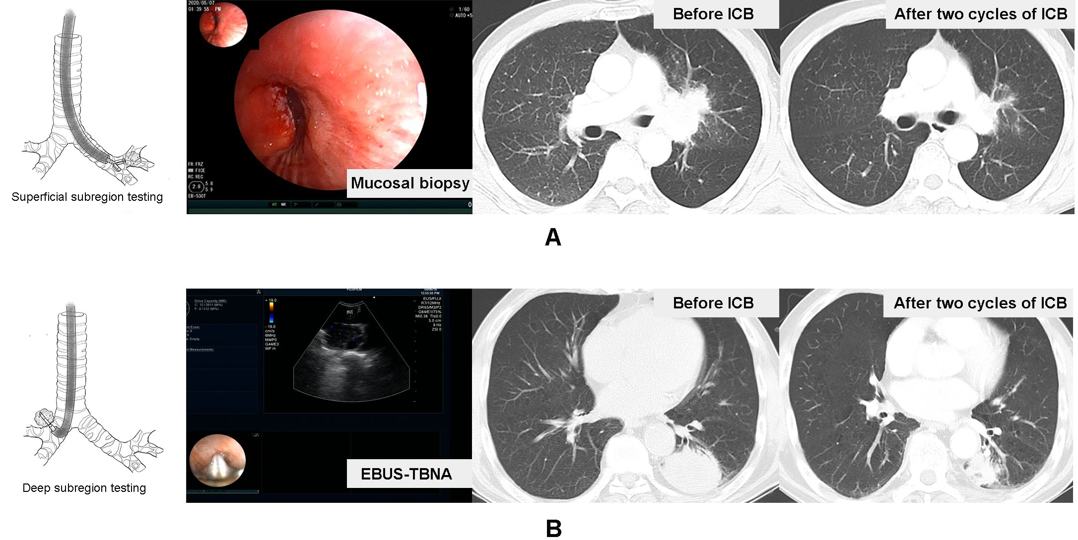 Diagram and imaging comparisons of lung regions are shown. In panel A, superficial subregion testing is highlighted with mucosal biopsy images and CT scans before and after two cycles of ICB. Panel B depicts deep subregion testing using EBUS-TBNA with ultrasound and corresponding CT scans before and after ICB treatment.