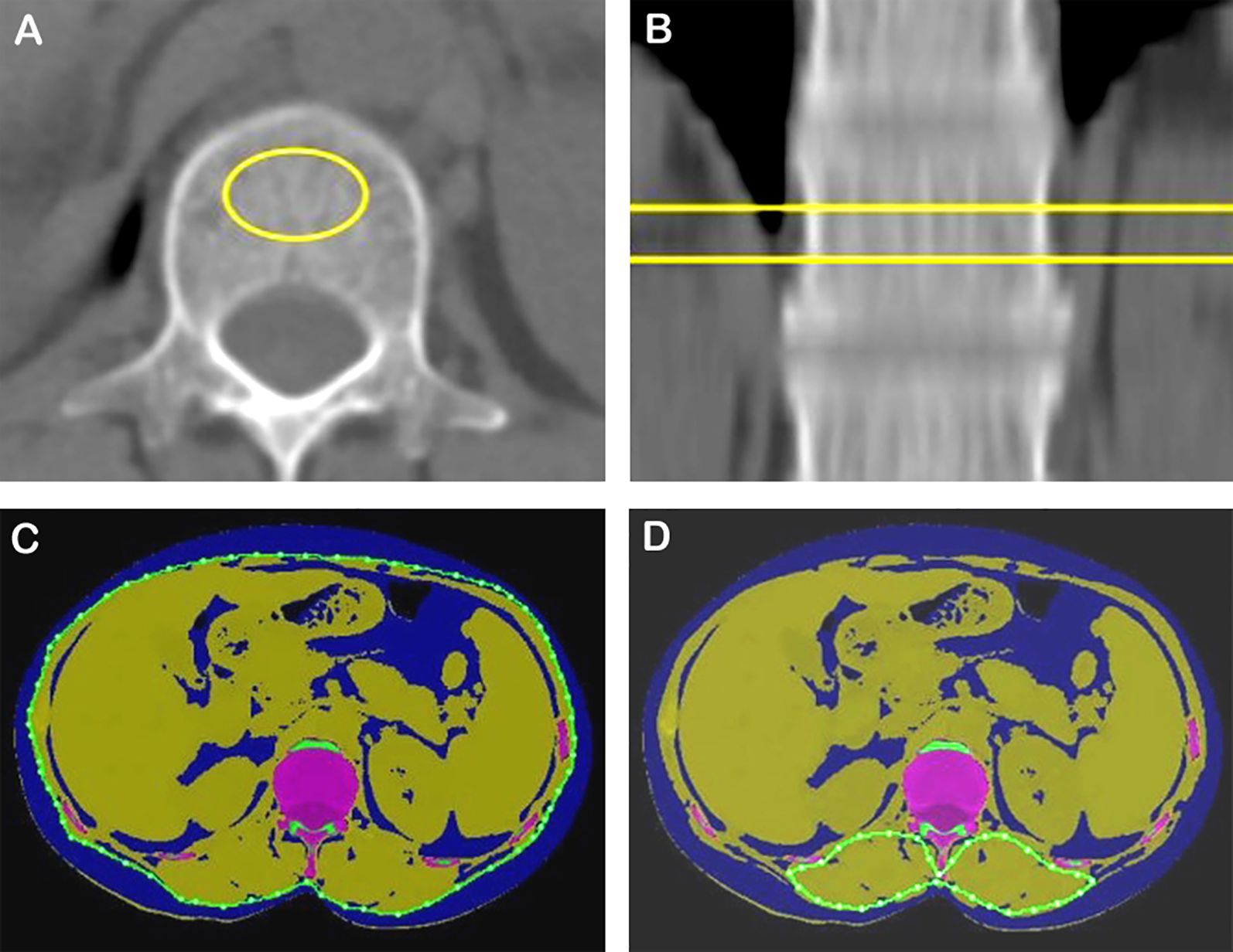 CT scan images with multiple views. Image A shows a cross-section of a spine with a yellow circle highlighting a specific area. Image B presents a sagittal view with two yellow lines. Images C and D display axial views with colored overlays on anatomical structures, including purple and green areas indicating distinct regions within the abdomen.