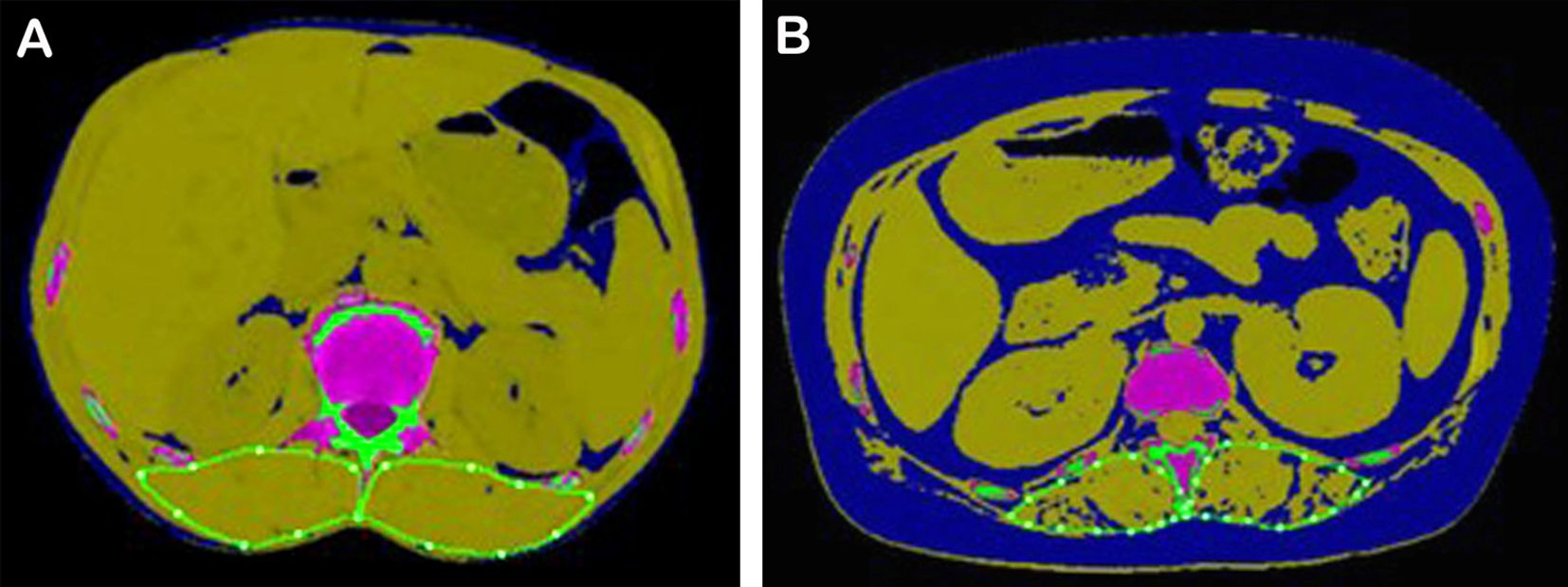 Cross-sectional CT scans labeled A and B, displaying color-coded anatomy. Yellow regions represent muscle, green regions depict subcutaneous fat, and pink areas illustrate visceral fat. Image A shows a higher proportion of subcutaneous fat, while image B highlights more muscle mass distribution. Both images outline organ structures in contrasting colors for clarity.