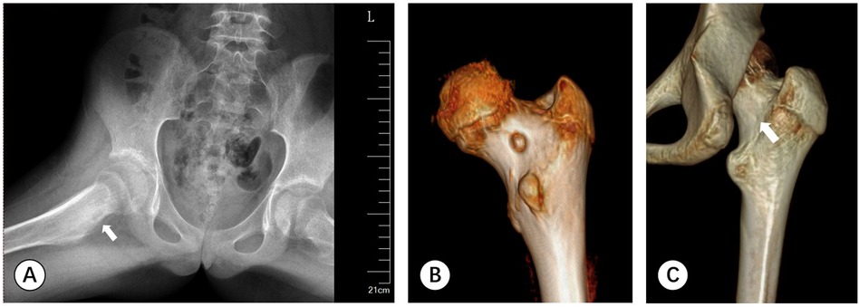 Panel A shows an X-ray of a pelvis with an arrow marking a detail on the left femur. Panel B presents a 3D CT scan rendering of the nidus on femur neck before operation. Panel C displays CT scan of the femoral neck after surgery with an arrow indicating the location of lesion.