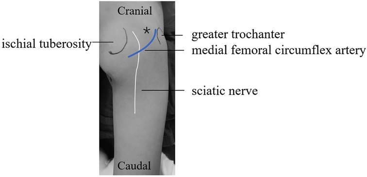Diagram of the posterior hip region, labeled with anatomical landmarks and structures. The ischial tuberosity is on the left. The greater trochanter is on the right. The blue line represents themedial femoral circumflex artery pathway, and the white line represents sciatic nerve pathway. The terms