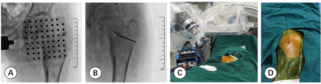 Image showing four panels labeled A to D: (A) X-ray with a grid overlay on the hip joint. (B) X-ray of a femur with a position line. (C) Patient under robot-assisted equipment. (D) Surgical site after localization with a needle inserted.