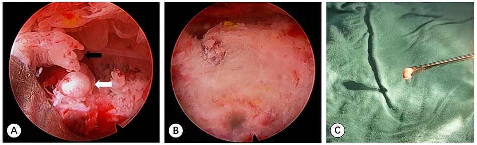 Panel A shows an endoscopic image with a circle-like mass indicated by a white arrow and a surrounding tissue indicated by a black arrow. Panel B displays the site after the removal of the mass, showing a smoother surface. Panel C depicts the extracted mass held by a medical instrument against a green fabric background.